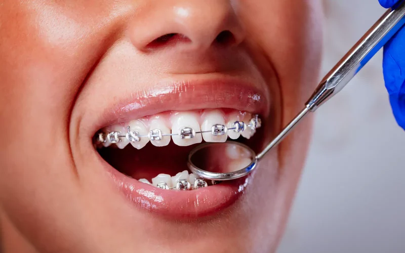 Orthodontists Putney – A close-up image of a patient receiving orthodontic care at a dental clinic in Putney. The individual is smiling, showcasing traditional metal braces fitted to the upper and lower teeth. A gloved orthodontist uses a dental mirror to examine tooth alignment and bracket positioning. The braces are secured with metal brackets and an archwire, indicating active teeth straightening treatment. This detailed image highlights the precision and care involved in orthodontic procedures, commonly offered by specialist orthodontists in Putney to correct misaligned teeth, improve bite function, and enhance long-term oral health.